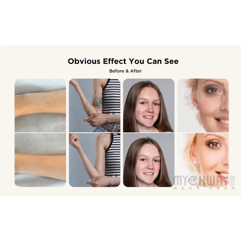 4 In 1 Professional Pico Laser Diode Hair Removal Skin Rejuvenation Machine