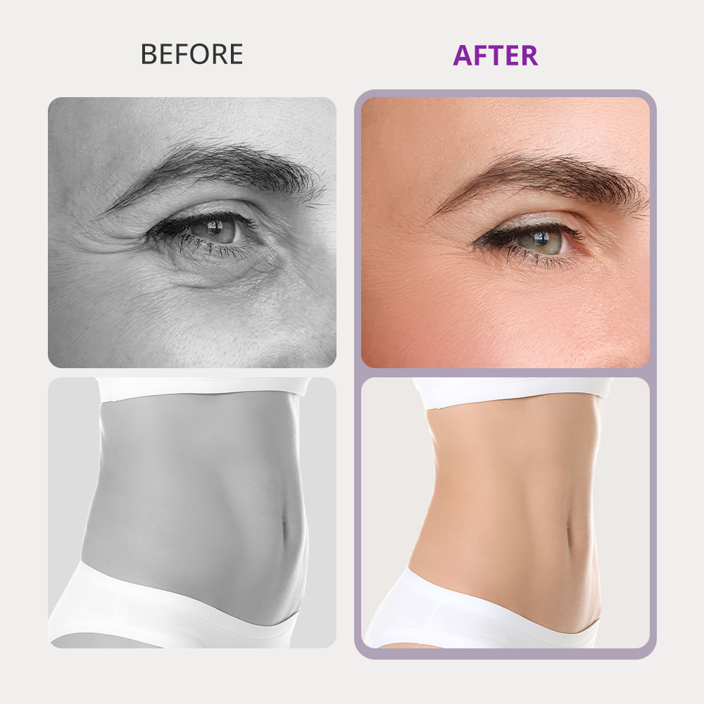 ARISTORM 10IN1 Cavitation RF Machine - myChway US