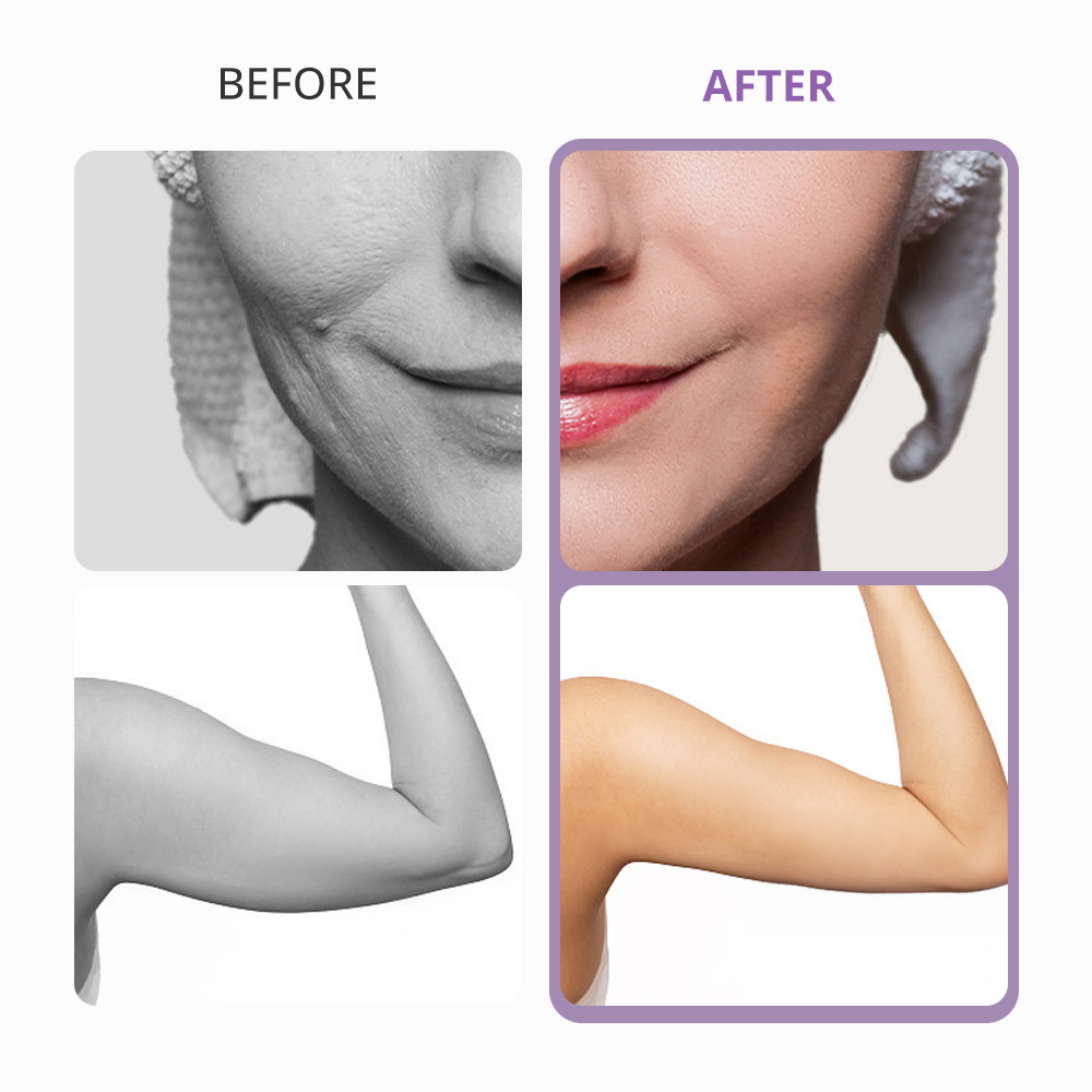 5in1 3D Smart RF 40k Unoisetion Cavitation Fat Burning Machine