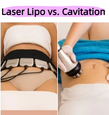 Laser Lipo vs. Cavitation: How to Choose Between Them